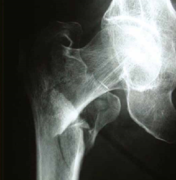 Image of a hip fracture - source National Hip Fracture Database